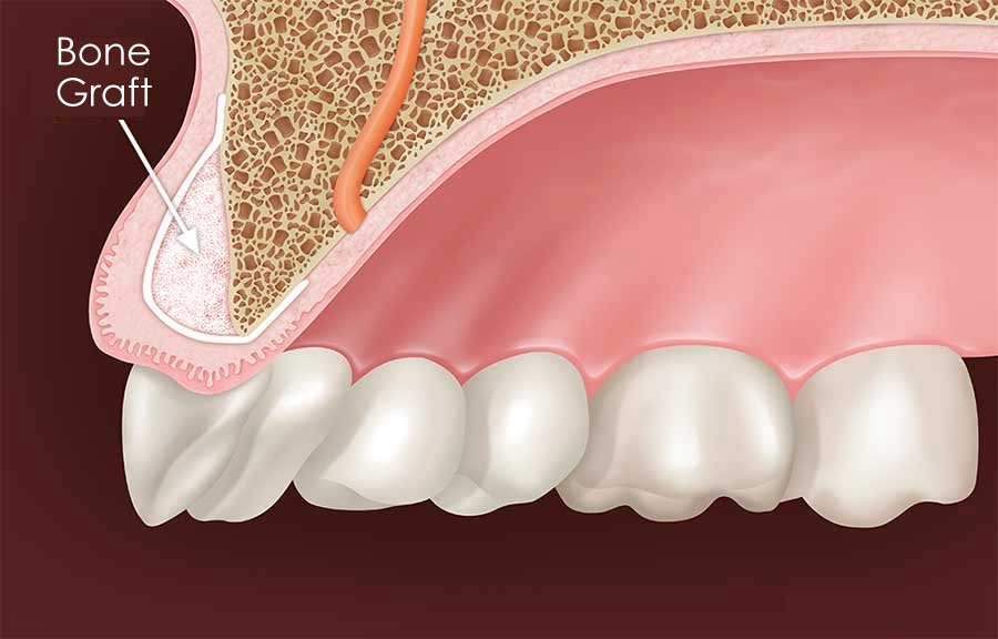 Riverside Bone Graft