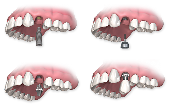 Riverside Dental Implants