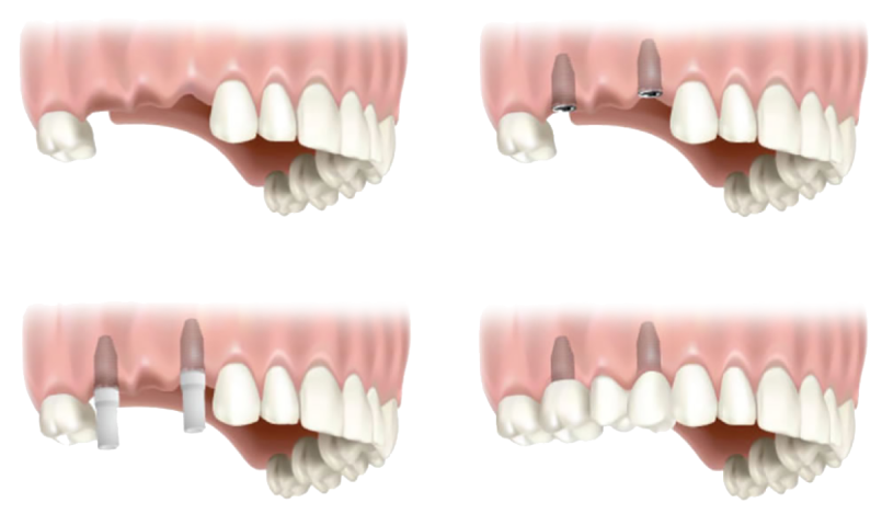 Riverside Dental Implants