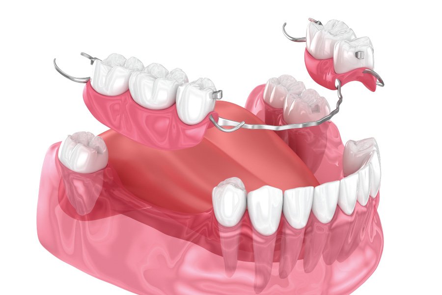 Riverside Partial Dentures